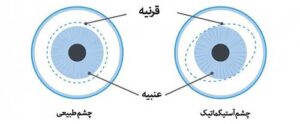 درمان آستیگماتیسم چشم