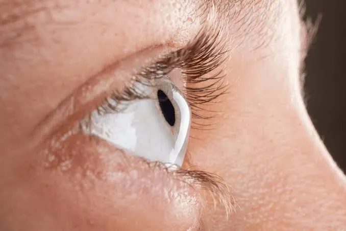 لنز تماسی مخصوص کراتوکونوس
